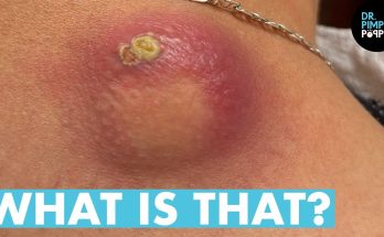 WHAT IS THAT! Dr Lee Pops Satisfying Back Cyst | Dr Pimple Popper Reacts